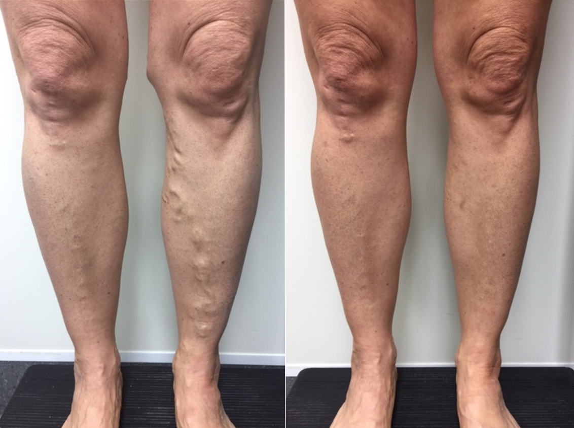Providing Non Surgical Treatments for Varicose and Spider Veins